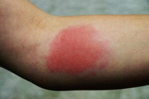 reaction from a european wasp sting